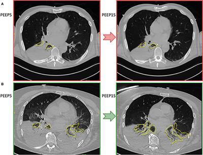 Effects of Positive End-Expiratory Pressure on Lung Recruitment, Respiratory Mechanics, and Intracranial Pressure in Mechanically Ventilated Brain-Injured Patients